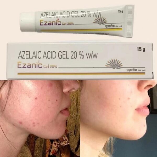 Ezanic Azelaic Acid Gel